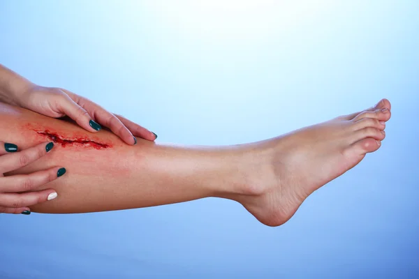 Yaralı bacak kan ile — Stok fotoğraf