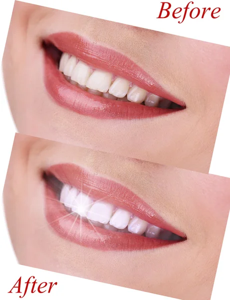 Kvinnan leende före besök tandläkaren och efter besök på nära håll — Stockfoto
