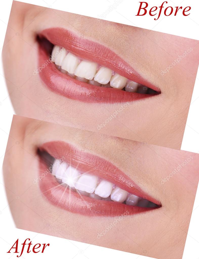 Woman smile before visit dentist and after visit, close up