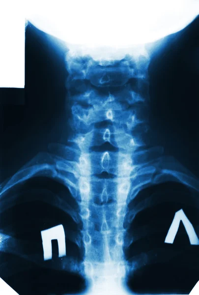 Рентген позвоночника человека, изолированный на белом — стоковое фото