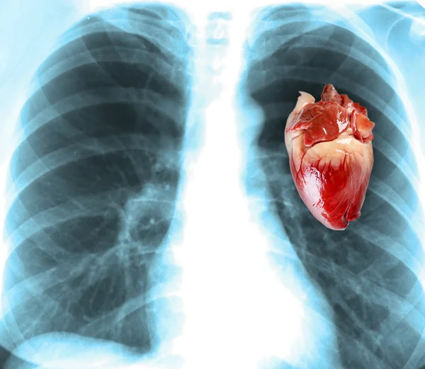 emberi szív röntgen koncepció — Stock Fotó © digitalstorm 6599658