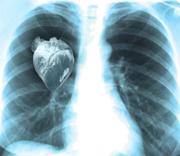 รังสีเอ็กซ์เรย์ของมนุษย์ด้วยหัวใจ — ภาพถ่ายสต็อก
