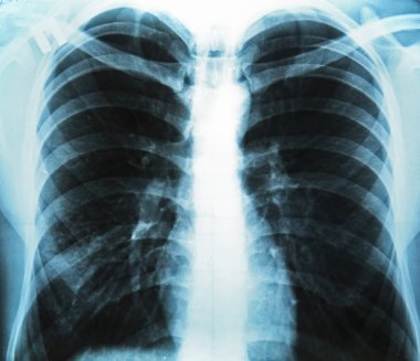 insan göğüs röntgeni