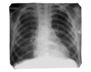 X-Ray görüntü izole 