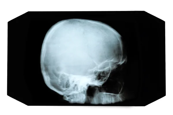 Рентгенівське зображення черепа — стокове фото