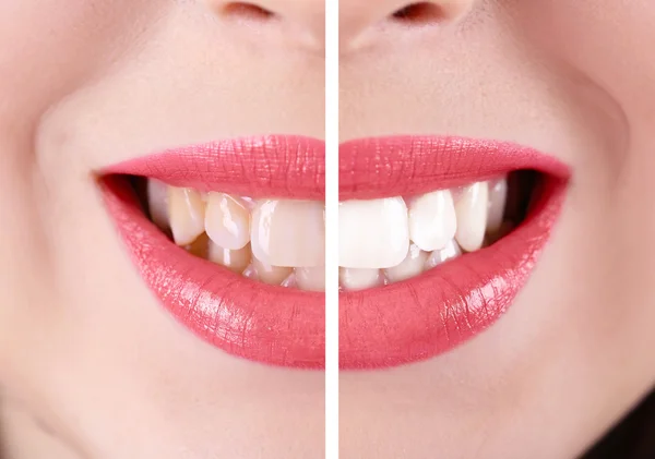 Dentes: antes e depois do conceito — Fotografia de Stock