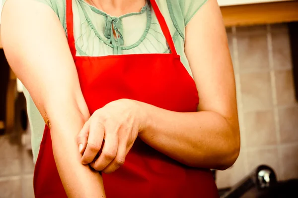 Mujer arañando el brazo con comezón. Alergia . — Foto de Stock