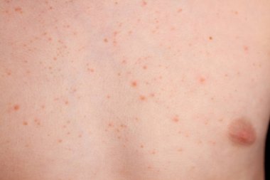 Şiddetli ürtizi olan küçük bir çocuğun vücudunun yakın görüntüsü, ısırgan otu isiliği de kovan olarak bilinir.