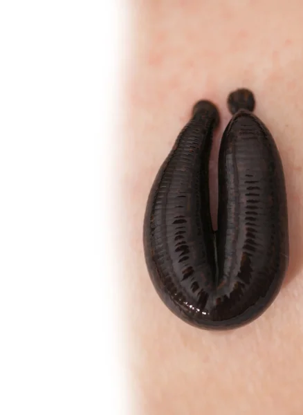 Hirudotherapy, medical leech — Stock Photo, Image