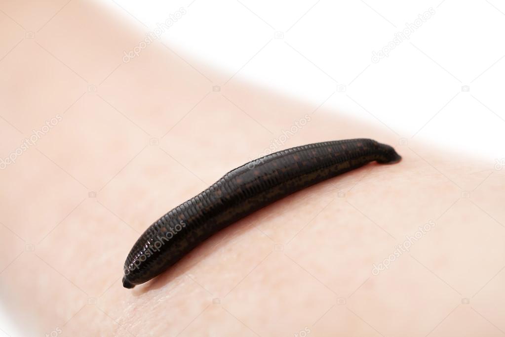 hirudotherapy, medical leech