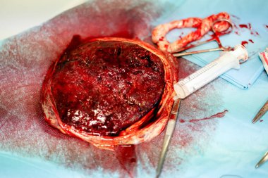 Doğum yaptıktan hemen sonra insan plasentası.