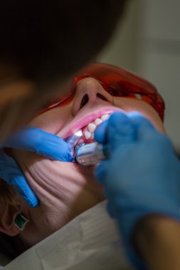 Diş diş teli almak