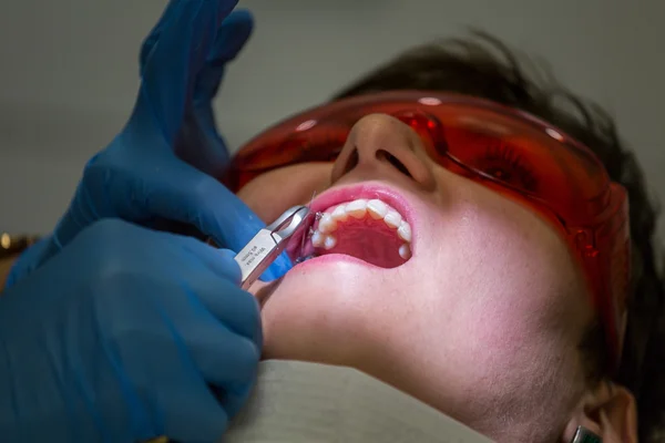 Ficando aparelhos nos dentes — Fotografia de Stock