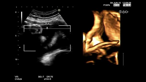 4d vysoce kvalitní ultrazvukové echografie šek. Gynekologické vyšetření. 33 týdnů těhotenství s 4d plod vykreslování šek — Stock video
