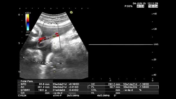 Hoge kwaliteit echografie echografie selectievakje. Gynaecologische medisch onderzoek. 33 weken oude zwangerschap met foetus heartbeat opname en thermische analyse — Stockvideo