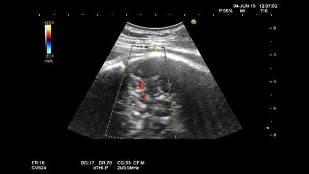 Hochwertige Ultraschall-Echographie-Untersuchung. gynäkologische Untersuchung. 33 Wochen alte Schwangerschaft mit Aufzeichnung des Herzschlags des Fötus und thermischer Analyse — Stockvideo