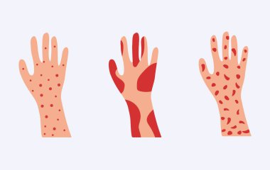 Skin allergy set. Hands covered red rash and scaling serious problems with psoriasis. clipart