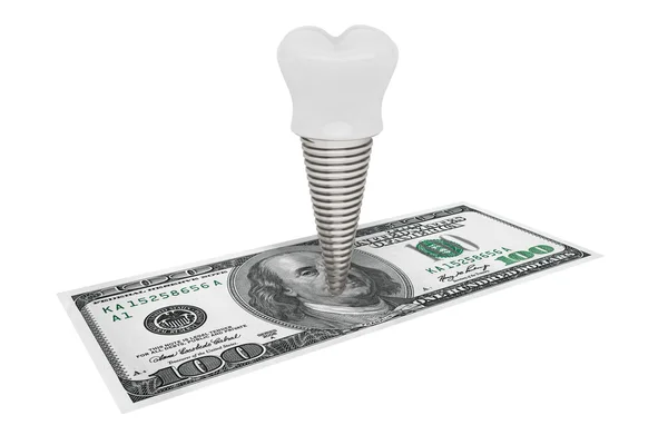 Coste del concepto dental. Implante dental con dinero — Foto de Stock