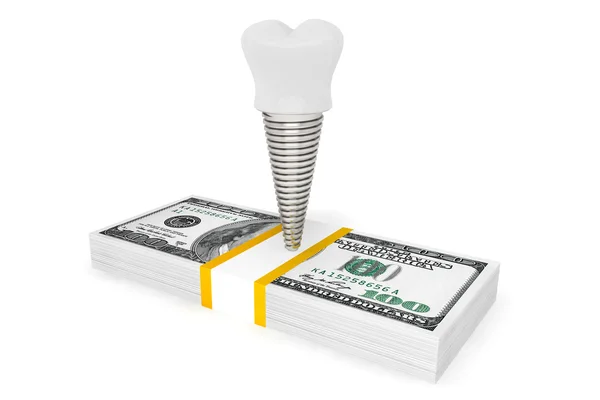 Coste del concepto dental. Implante dental con dinero —  Fotos de Stock