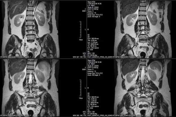 척추의 Mri Lumbar Thoracic 초음파 컴퓨터 모니터로 사람의 척추를 촬영하는 — 스톡 사진