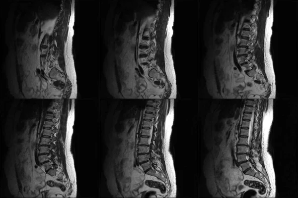 척추의 Mri Lumbar Thoracic 초음파 컴퓨터 모니터로 사람의 척추를 촬영하는 — 스톡 사진