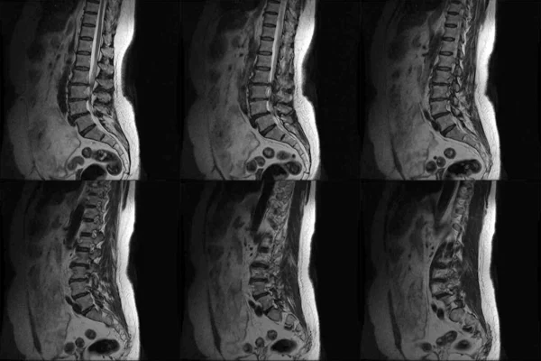 Mágneses Rezonanciás Képalkotás Emberi Gerincről Ágyéki Mellkasi Gerinc Mri Emberi — Stock Fotó