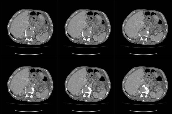 КТ - компьютерная томография всего живота с контрастом. Компьютерная томография всего живота в осевой. Часть двенадцать