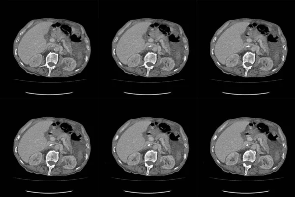 Scan Computertomografie Van Hele Buik Met Contrast Computertomografie Hele Buik — Stockfoto