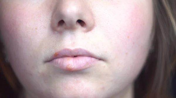 Primer plano de la enfermedad del herpes en los labios de una niña. Medios. Detalles de la cara femenina con manchas virales, concepto de medicina y enfermedades. — Foto de Stock