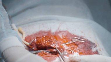 Bloody operation on organ. Action. Close-up of lot of blood during surgery on male genital organ. Fracture of penis or its increase with surgery