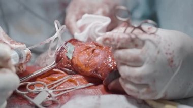  Operation on male organ. Action. Specialized surgical operation on male sexual organ. Operation of penis fracture or its enlargement. Close-up of surgeons performing surgery on male sexual organ