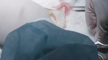 Cerrahlar açık kesiklerle ameliyat yaparlar. Başla. Cerrahi alanında iç dokuları açık küçük bir kesik. Cerrahlar iç doku yaralarını kesip dikerler.