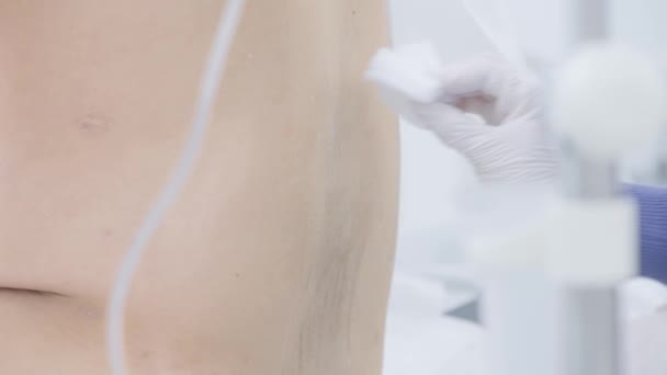 Sköterska torka injektionsstället. Börja. Sköterskan torkar injektionsstället med spritservett. Förberedelse av injektion i sidan av buken — Stockvideo