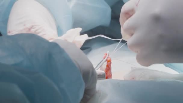 Os cirurgiões de perto cosem o processo. Acção. Cirurgiões profissionais aplicam pontos na veia arterial. Suturas cirúrgicas em processos internos de órgãos — Vídeo de Stock