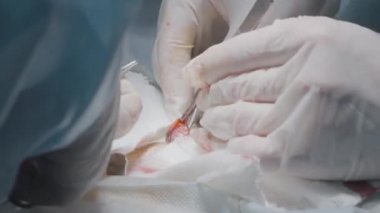 Doktorlar apandisti almak için ameliyat yaparlar. Başla. Cerrahlar anestezi altında kişiyi ameliyat ederler. Tümör alınması ve organ ameliyatı