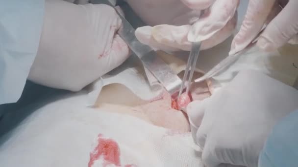 Les chirurgiens retirent l'organe du corps. L'action. Les chirurgiens ouvrent l'incision pour atteindre l'organe. Chirurgie interne des organes ou ablation d'appendicite — Video