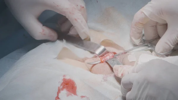 Los cirujanos sacan el órgano del cuerpo. Acción. Los cirujanos abren la incisión para llegar al órgano. Cirugía de órganos internos o extracción de apendicitis —  Fotos de Stock