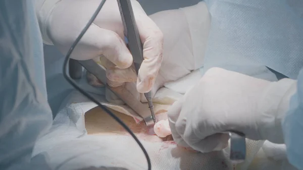 Χειρουργικό νυστέρι λέιζερ. Πάμε. Ωραίες τομές με νυστέρι λέιζερ. Χειρουργός κόβει και καυτηριάζει ιστό με νυστέρι λέιζερ. Χειροκίνητο νυστέρι laser για ακριβείς τομές στο χειρουργείο — Φωτογραφία Αρχείου
