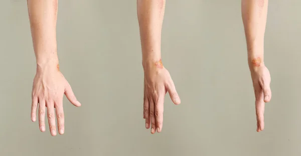 På nära håll beskåda av elaka sår på handleden från olika vinklar — Stockfoto
