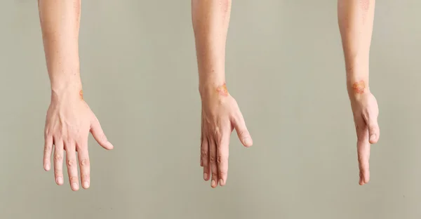 Vista de cerca de heridas desagradables en la muñeca desde diferentes ángulos —  Fotos de Stock