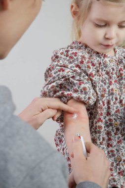 Anne, kızının kolundaki kırmızı ve kaşındıran egzamaya merhem sürüyor. Küçük kız atopik dermatitten muzdarip..