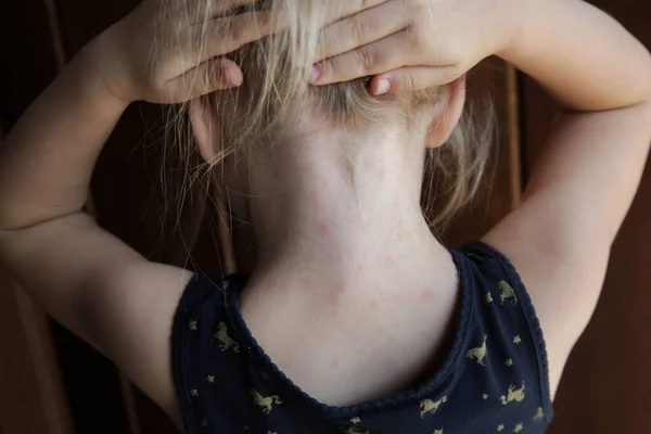 Nyári Kiütés Gyakori Kisgyermekkori Bőrkiütések Vagy Allergiás Reakció Vörös Foltokkal — Stock Fotó