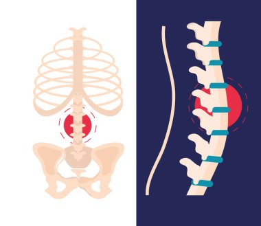 arthritis rheumatology spine clipart