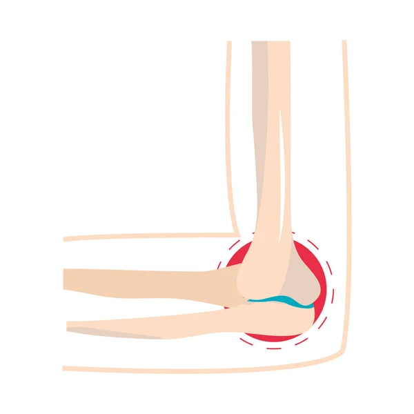 Rheumatism joint pain — Stock Vector