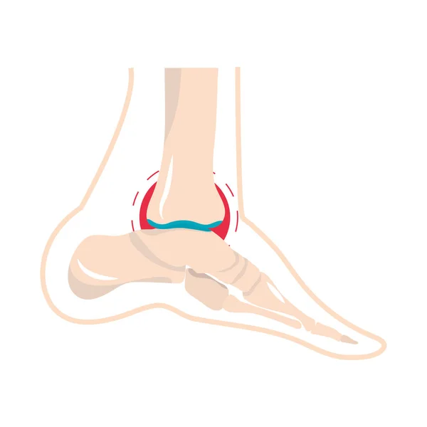 Douleur arthrite rhumatologie — Image vectorielle