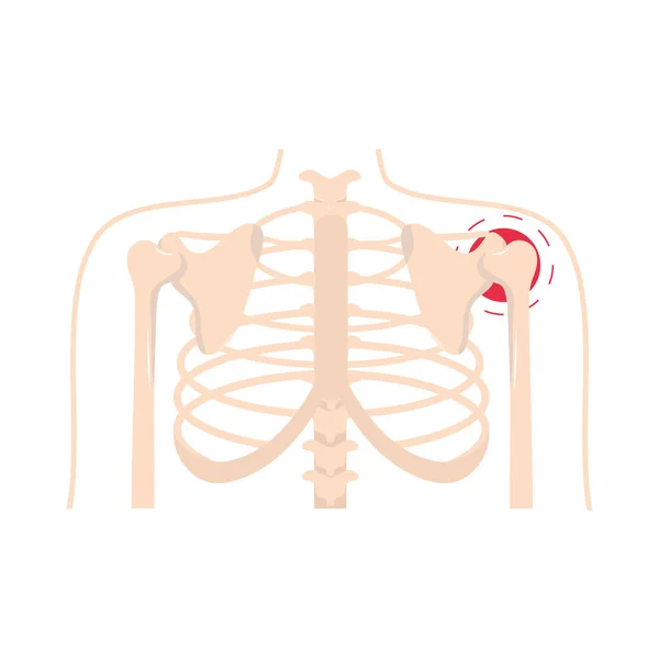 风湿性关节炎肩痛 — 图库矢量图片
