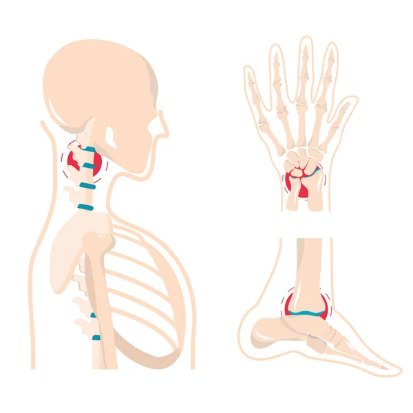 Human bones arthritis — Stock Vector