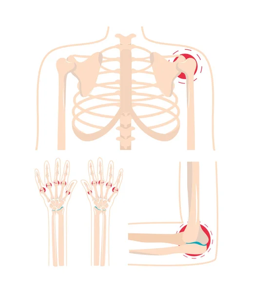 Artritis lesión dolorosa — Vector de stock