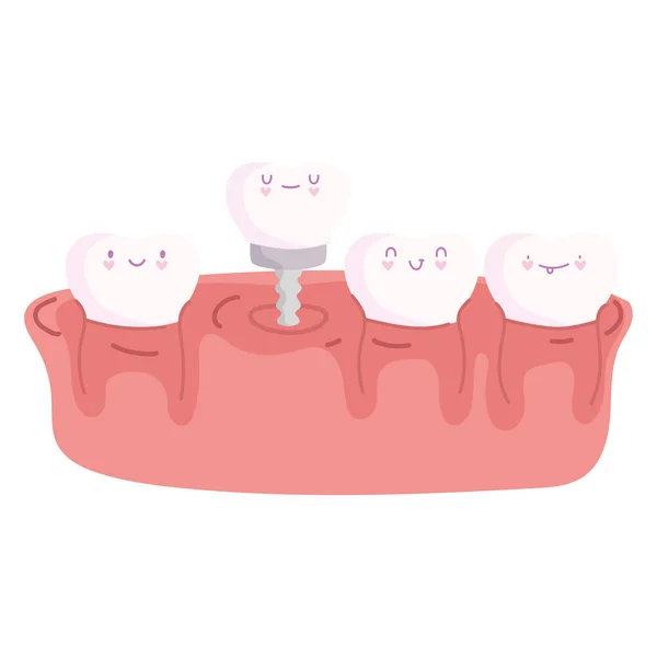 Tandenimplantaat tandvlees — Stockvector