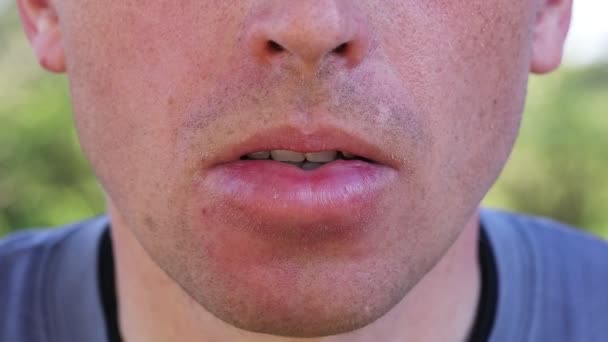 Lower Lip Swollen Face Swelled Bee Sting — Stock Video